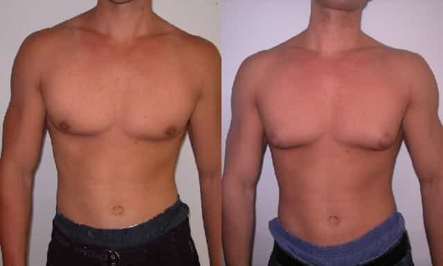 女性化(アロマ化)による女性化乳房